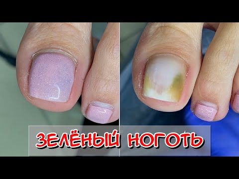Видео: Зеленый ноготь / Синегнойная палочка / Позеленел ноготь / Онихолизис / Кто живет под ногтем? /