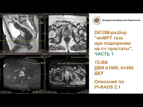 Видео: Мультипараметрическая МРТ таза при подозрении на рак простаты. Часть 1: описание по PI-RADS 2.1