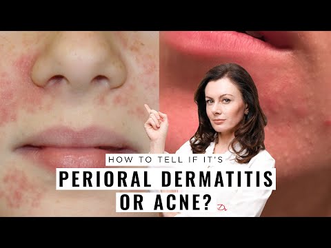 Видео: Периоральный дерматит или акне? Как отличить | Доктор Сэм Бантинг