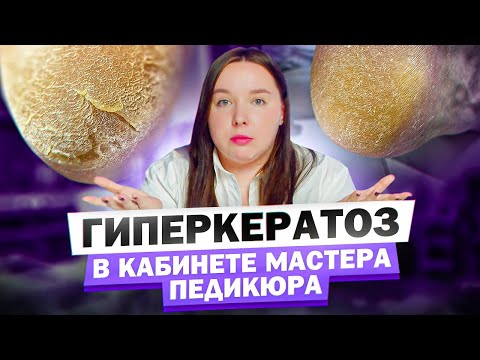 Видео: Гиперкератоз. Причины и как быть мастеру педикюра?