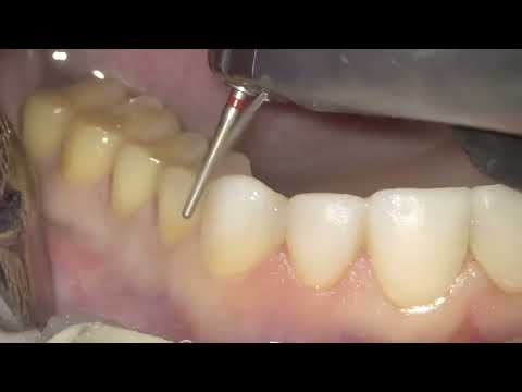Видео: Александр Бабуров - Препарирование жевательных зубов под щёчно-окклюзионные виниры