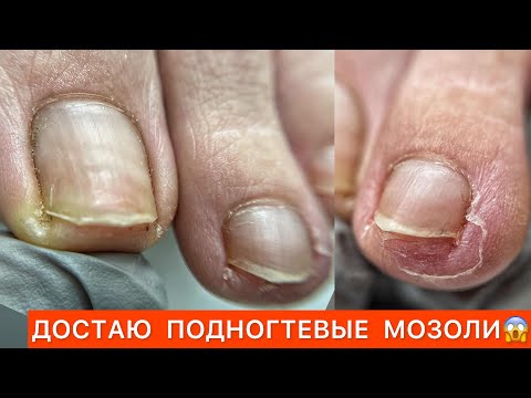 Видео: ПЕДИКЮР😎КАК РАСПОЗНАТЬ НЕЛАДНОЕ 🤨