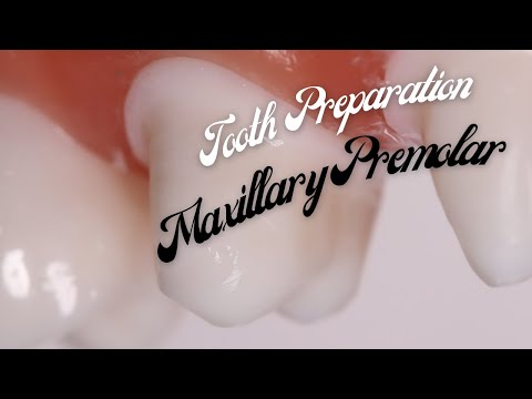 Видео: Подготовка зубов к PFM 🔵 Первый премоляр верхней челюсти 🟡 Пошаговая демонстрация