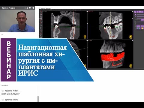 Видео: Вебинар_Навигационная шаблонная хирургия с имплантатами ИРИС
