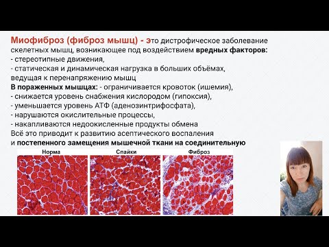 Видео: Моя история болезни и лечения. Миофиброз. Миофасциальный синдром (МФС). Фиброз мышц живота