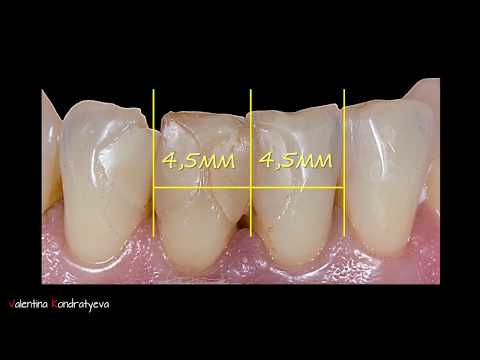 Видео: Препарирование нижних резцов