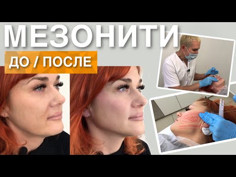 Видео: МЕЗОНИТИ ДО и ПОСЛЕ | Ставим Нити COG, профилактика старения лица #мезонити #подтяжкалица