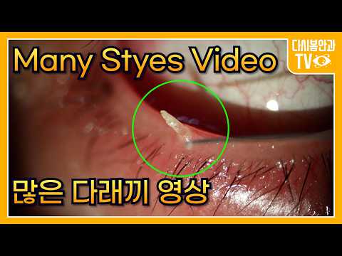 Видео: Лечение многочисленных ячменей