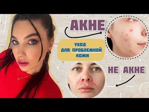 Видео: УХОД ДЛЯ ПРОБЛЕМНОЙ КОЖИ / ВСЕ О ПРЫЩАХ / ПОЧЕМУ ВОЗНИКАЮТ ПРЫЩИ?