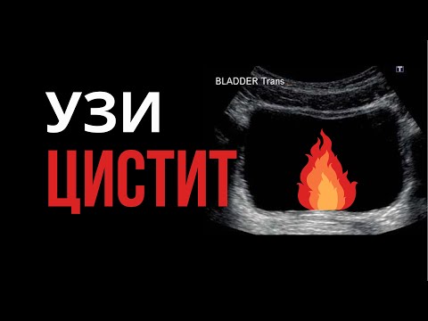 Видео: Цистит и УЗИ. Ультразвуковая картина некоторых видов острого и хронического цистита