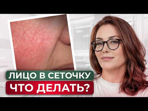 Видео: Как избавиться от сосудов на лице? ЛУЧШЕЕ ЛЕЧЕНИЕ КУПЕРОЗА И РОЗАЦЕА!