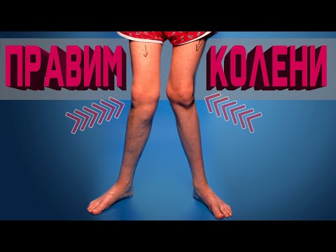 Видео: ❌-образные колени. Как исправить?