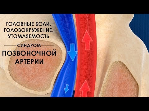 Видео: Головные боли, головокружение, утомляемость - синдром позвоночной артерии