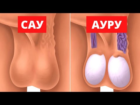 Видео: Байқамайтын ауру! Варикоцеле қалай пайда болады? варикоцеле ауруы. Жыныстық мүше ауруы.
