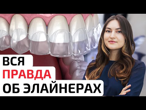 Видео: Элайнеры или брекеты: что выбрать? Эффективность и нюансы ношения