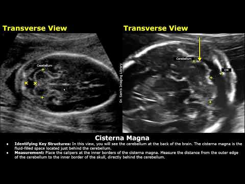 Видео: Как измерить большую цистерну плода на УЗИ | Сканирование аномалий головного мозга плода | Акушер...