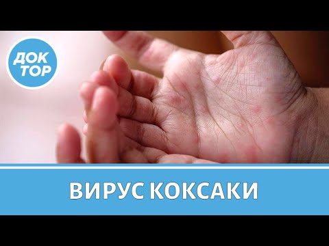 Видео: Вирус Коксаки и другие энтеровирусы | Как снизить риск заражения