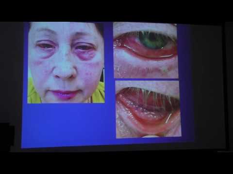 Видео: Когда нужно лечить сухой глаз у больных глаукомой