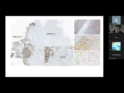 Видео: Чиж Григорий Алексеевич "Возможности и противоречия таргетной терапии рака молочной железы".