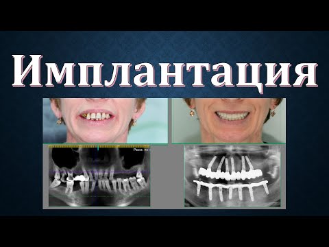 Видео: Секреты Стоматологии - Глава 6. Имплантация