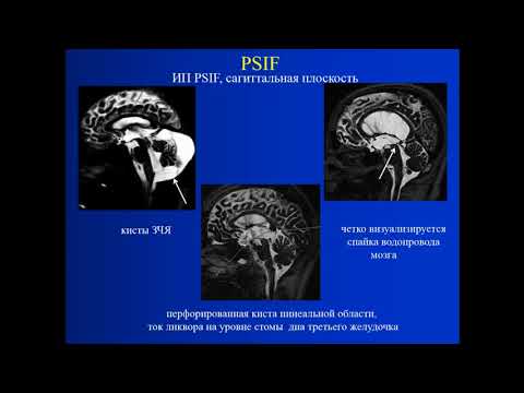 Видео: Пашкова А.А. «Магнитно-резонансная томография в диагностике гидроцефалии»