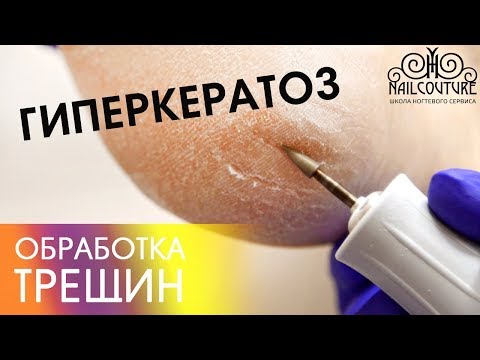 Видео: Аппаратный педикюр. Гиперкератоз. Обработка трещин в аппаратном педикюре.