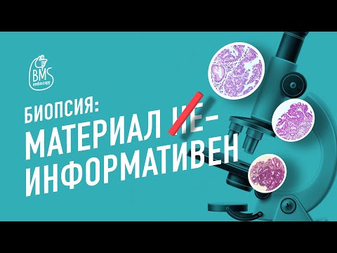 Видео: БИОПСИЯ и РАК ЖЕЛУДКА: результат между бранш. Если эндоскопия, то морфология