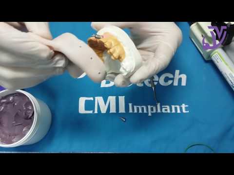 Видео: Протокол снятия оттиска трансфером для открытой ложки