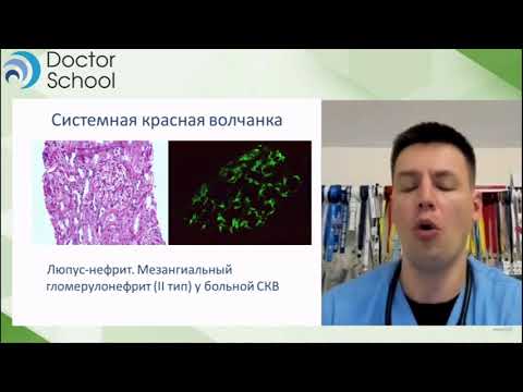 Видео: Волчаночный нефрит. Поражение почек при СКВ