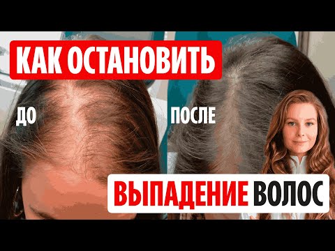 Видео: Как остановить выпадение волос из любого состояния. В домашних условиях.