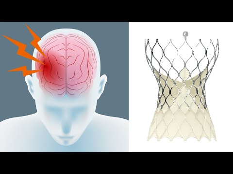 Видео: Риск инсульта и транскатетерная замена аортального клапана (TAVR) с доктором Айзеком Джорджем