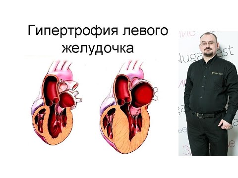Видео: Гипертрофия левого желудочка – проявление и лечение.