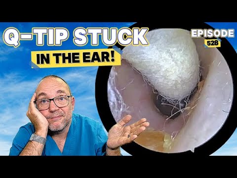 Видео: Ватная палочка застряла в ухе! Выпуск 528 (и возвращение шуток дня про отцов!)