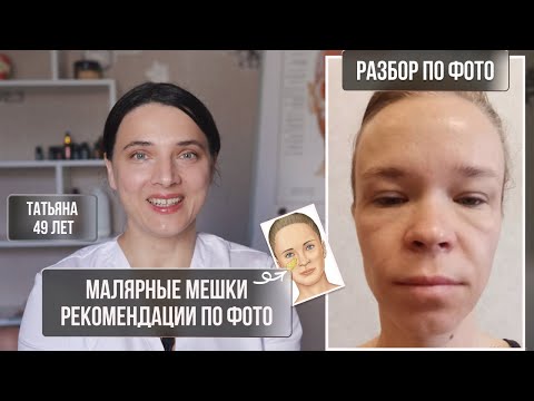 Видео: Убираем малярные мешки и отек лица. Мои рекомендации