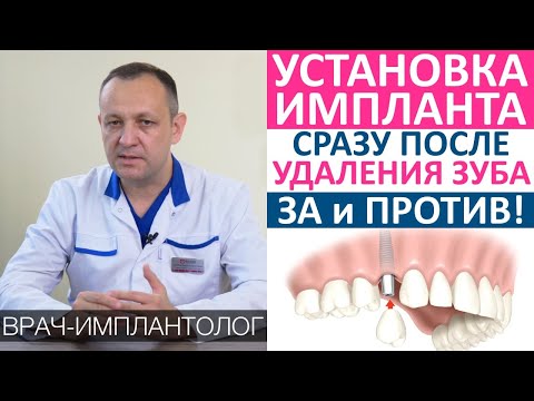 Видео: Установка зубного импланта сразу после удаления зуба. За и против! Одномоментная имплантация зубов.