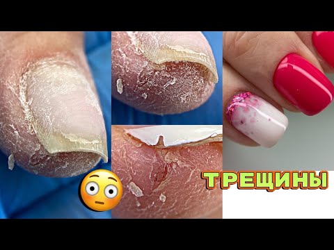 Видео: Отваливается кожа 😕 Трещины на пальцах / Как поднять клюющий ноготь / Маникюр