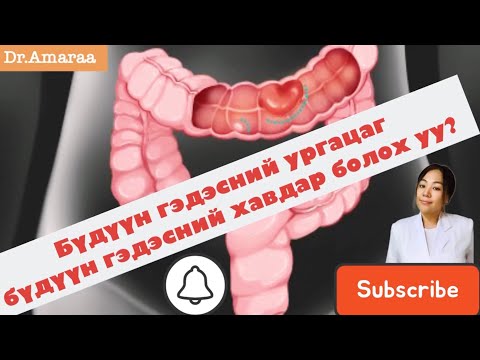 Видео: Бүдүүн гэдэсний ургацаг бүдүүн гэдэсний хавдар үүсгэдэг үү?