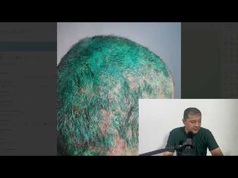 Видео: Санчикли бош огриклари , кайси касалликлар сабаб булади ,фарклари хакида батафсил 