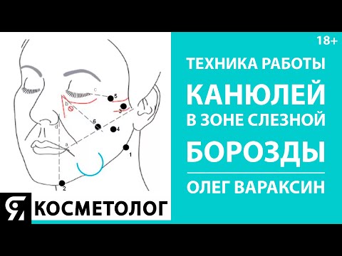Видео: Техника работы канюлей в зоне слезной борозды Олег Вараксин врач косметолог, дерматовенеролог