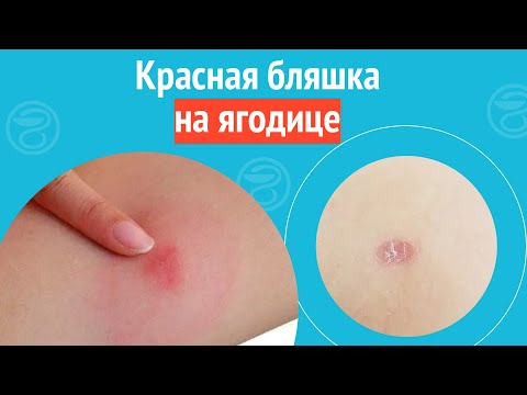 Видео: 🦵 Красная бляшка на ягодице. Клинический случай №1199