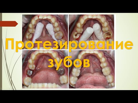 Видео: Секреты Стоматологии - Глава 4. Протезирование.(Коронки, Виниры)