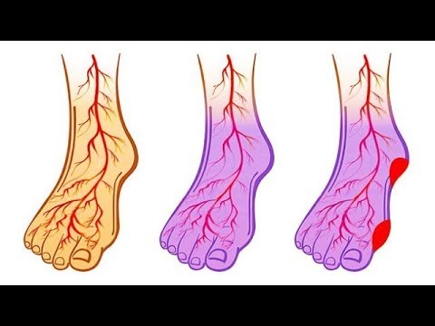Видео: Если у Вас Высокое Давление Или Варикоз, Начните Делать Это