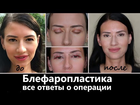 Видео: Блефаропластика цена врач реабилитация