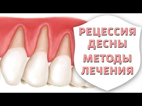 Видео: Рецессия десны. Оголилась шейка зуба - мифы и правда о лечении | Воспаление десен | Дентал ТВ