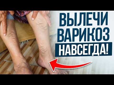 Видео: ИЗБАВЬСЯ от ВАРИКОЗА раз и НАВСЕГДА! / Первопричины и метод борьбы с расширением вен