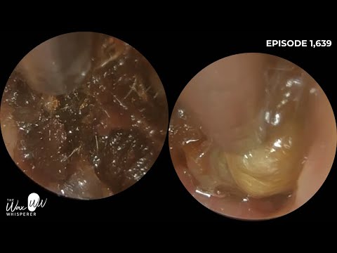 Видео: 1639 — 6-летняя ушная сера удалена с помощью iCLEARscope®️