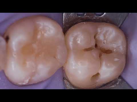 Видео: 47 зуб метод окклюзионного штампа