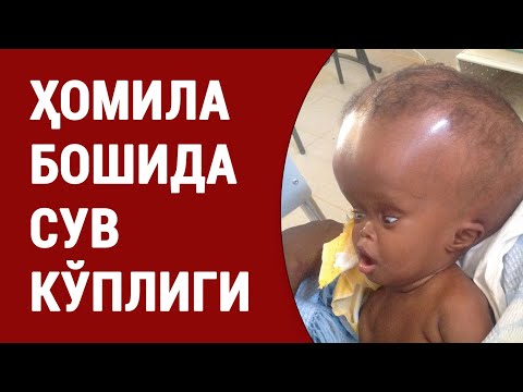 Видео: Ҳомила бошида сув кўплиги