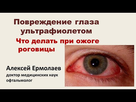 Видео: Ультрафиолет - воздействие на глаза. Световые ожоги роговицы. #ЛечимсяПравильно