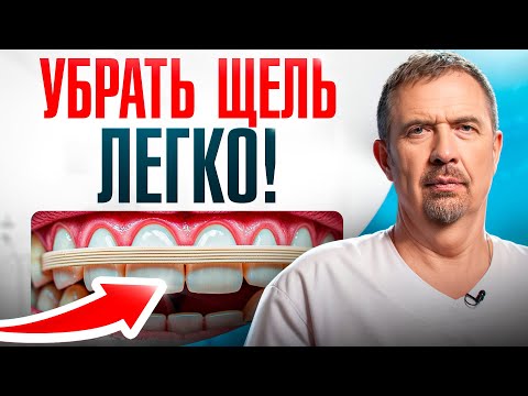 Видео: 3 способа убрать щель между зубов